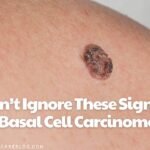 Don’t Ignore These Signs of Basal Cell Carcinoma