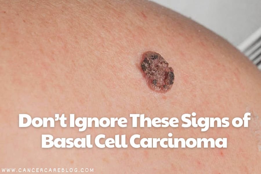 Don’t Ignore These Signs of Basal Cell Carcinoma