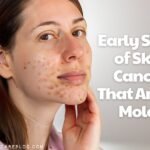 Early Signs of Skin Cancer That Aren’t Moles