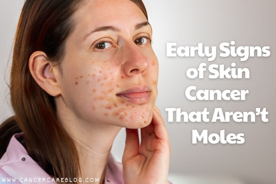 Early Signs of Skin Cancer That Aren’t Moles