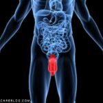 Testicular Cancer