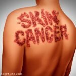 skin cancer Basal Cell Carcinoma The Skin Cancer You Shouldn’t Ignore