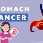 stomach cancer diagnosis